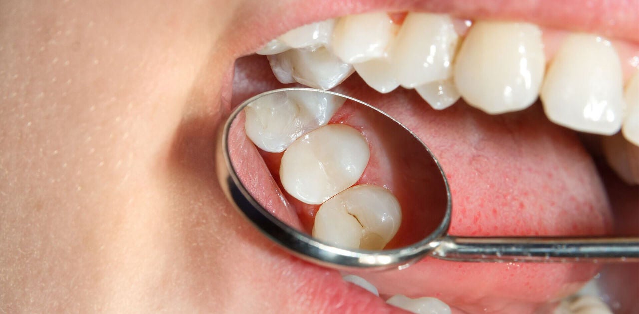 Popunjavanje zuba dentalnim kompozitima
